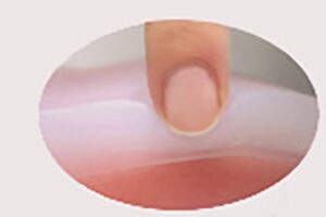 denture_img002
