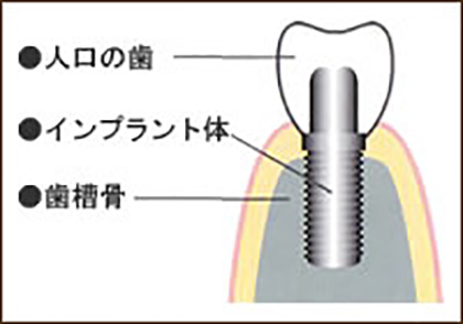 インプラント治療とは?