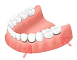 implant_img004