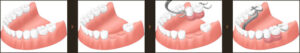 implant_img005
