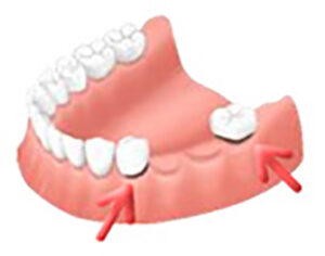 implant_img006
